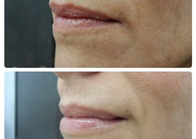 Resultados de rellenos de labios Dra Elisa Matehus (5)