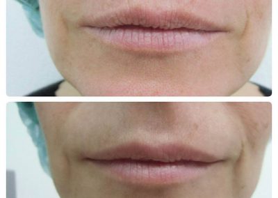 Resultados de rellenos de labios Dra Elisa Matehus (8)