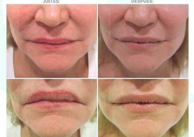 Resultados de rellenos de labios Dra Elisa Matehus (9)